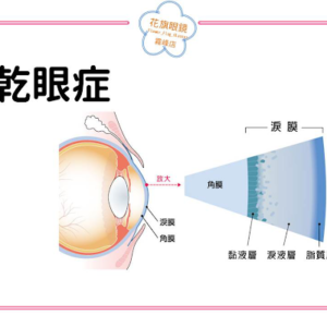 乾眼症 花旗眼鏡 霧峰店