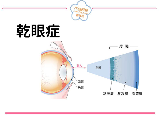 乾眼症 花旗眼鏡 霧峰店